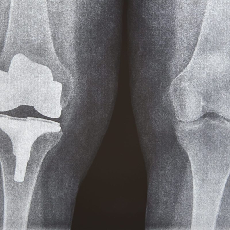 knee-cap-replacement-xrays-titanium-implant-oste-2023-11-27-05-29-49-utc (1) (1) (1) Radiografía de unas rodillas, una de ellas con protesis